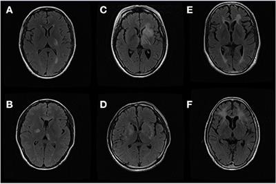 Comparison of Thalamus and Basal Ganglia Signs Between Multiple Sclerosis and Primary Angiitis of the Central Nervous System: An Exploratory Study